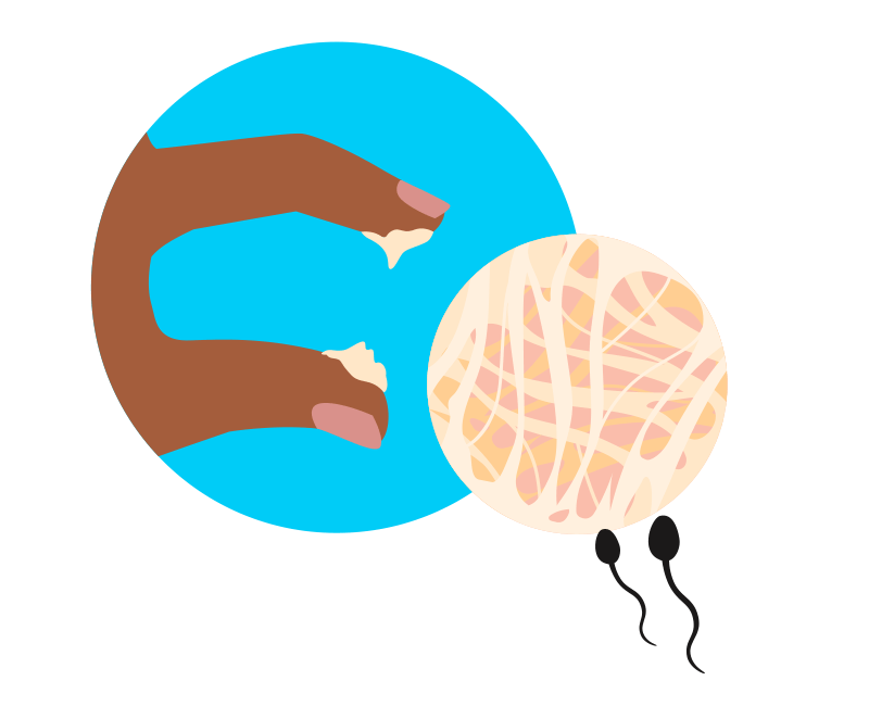 Illustration: zwei Finger mit hellgelbem Zervixschleim von cremig-fester Konsistenz, daneben eine vergrößerte Ansicht der Zervixschleimstruktur mit verschränkten Linien, die die Undurchlässigkeit für zwei darunter abgebildete Spermien symbolisieren soll